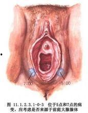 前庭大腺脓肿手术视频,前庭大腺脓肿手术操作步骤详解