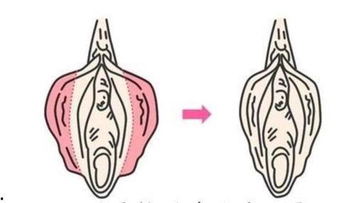 前庭大腺脓肿手术视频,前庭大腺脓肿手术操作步骤详解