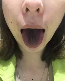 吃瓜尖舌头会黑,吃瓜尖舌头变黑之谜
