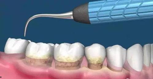 超声洁牙视频,高效牙齿清洁体验
