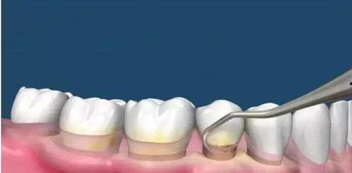 超声洁牙视频,高效牙齿清洁体验