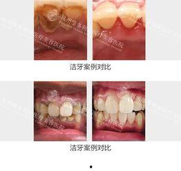超声洁牙视频,高效牙齿清洁体验