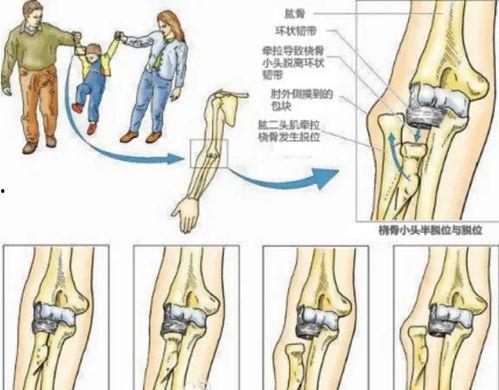 桡骨小头半脱位复位视频,桡骨小头半脱位复位操作步骤详解