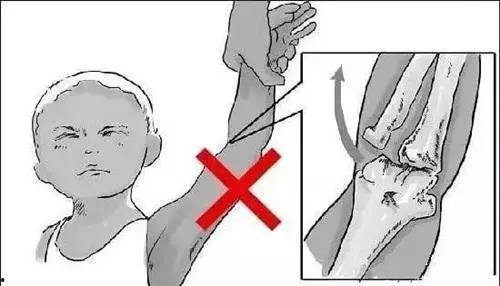 桡骨小头半脱位复位视频,桡骨小头半脱位复位操作步骤详解