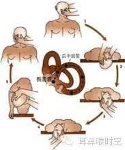 耳石复位法视频,轻松缓解眩晕，恢复平衡感