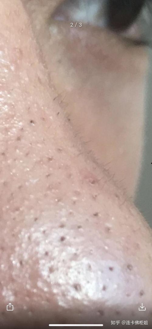 清理鼻子黑头视频,跟随专业视频学习鼻子清洁技巧