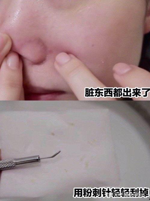 清理鼻子黑头视频,跟随专业视频学习鼻子清洁技巧