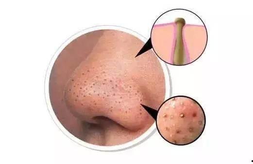 清理鼻子黑头视频,跟随专业视频学习鼻子清洁技巧