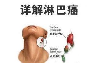 淋巴结触诊视频,实用操作步骤解析