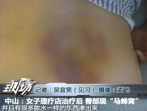 女人臀部针灸视频,女性健康与塑形的秘密之道