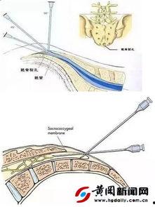 骶管注射疗法视频,视频解析与操作指南